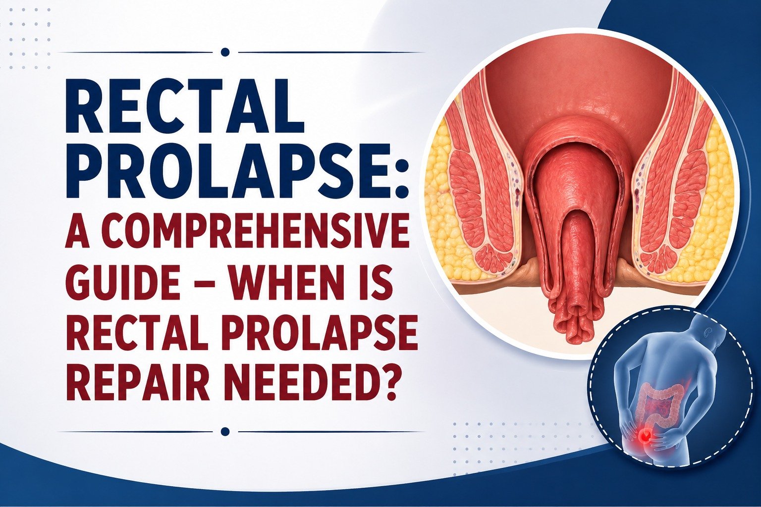 Rectal Prolapse – Comprehensive guide When is the repair needed